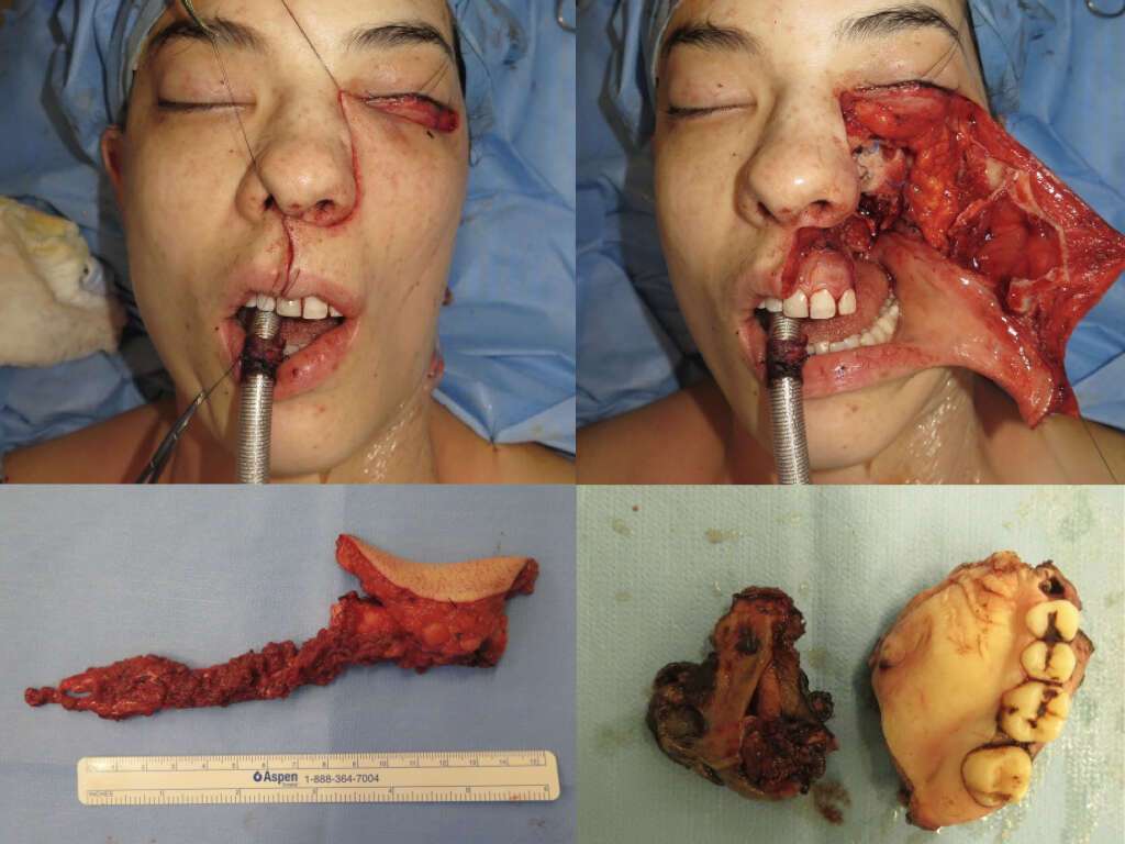 Up, left: Weber Ferguson approach. Up, right: Maxillary swing. Bottom, left: Fibula flap. Bottom, right: Product of AVM resection.